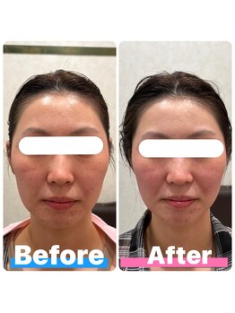 アーシャ(Arsha)/小顔コルギ