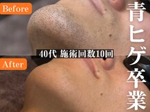 before＆afterはフォトギャラリーをご参照ください！！#ヒゲ脱毛