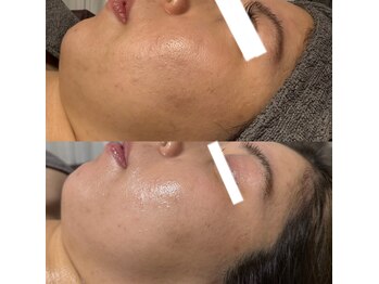 エステ リラクゼーションサロン(more)/毛穴・くすみ・乾燥肌改善