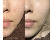 トリンテ バイ フェース(TRINTE by FAITH)/【セルサーリペアマスク】6回