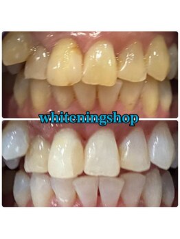 ホワイトニングショップ 盛岡店(WHITENINGSHOP)/ブライダルクーポン有♪