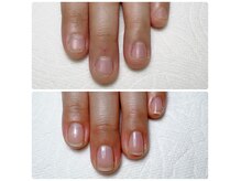 深爪や噛み爪は自爪育成でお悩み解決