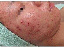 ビューティーメイクさくら/ポツポツ肌