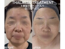 《タラソハーブピーリング×美脳小顔ヘッドスパ》1回で瞬殺小顔