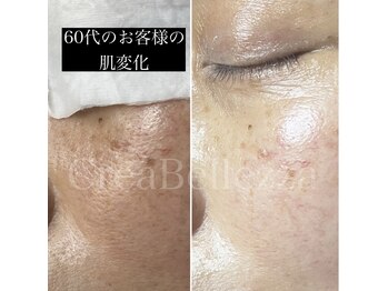 クレアベレッツァ(Crea Bellezza)/60代のお客様の肌変化♪