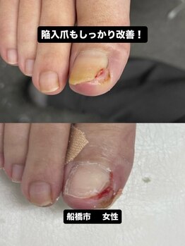 巻き爪じゅん 千葉駅前店/陥入爪の痛みを丁寧にケア