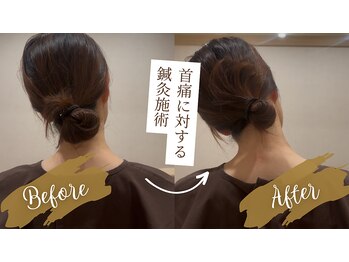 エヌアンドエヌ鍼灸院 福住店(N&えぬ鍼灸院)/鍼灸・整体 Before & After