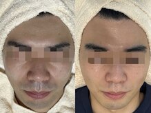 エミュ(emu formen)/髭の途中経過ここまでクリアに