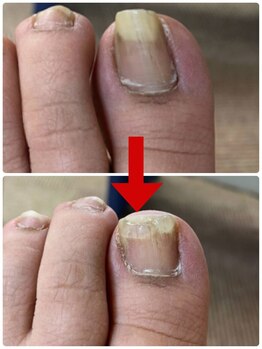 名古屋駅前巻き爪センター/巻き爪