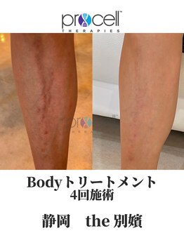 ザ ベッピン(the 別嬪)/古傷や肉割れなどボディも可能！