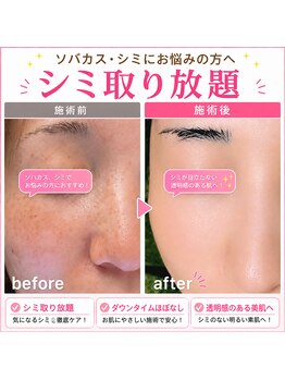 ココスタイルビューティー(COCOSTYLE beauty)の写真/シミスポットし放題、顔全体のトーニング