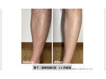 レイカ(Reica)/◆メンズ脱毛（全身）