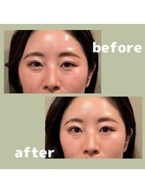 プラス(APLUS)/美容鍼灸　施術前後