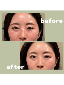 プラス(APLUS)/美容鍼灸　施術前後