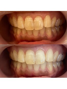 フワリ(Fuwari)/美歯口ホワイトニング