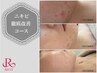 【頑固なニキビにお悩みの方はコチラ！】REVIハーブピーリング　￥15000