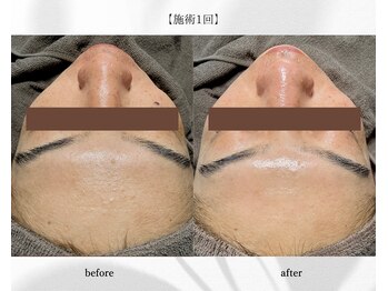 アン ビューティー(ann beauty)/施術1回【症例写真】40代