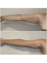 賢者のボディケア/革命的な脂肪分解液×インディバ