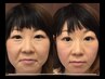 【初回限定♪】　小顔矯正〈エラ・頬骨特化コース〉　￥10000→7800円
