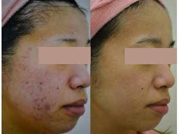 アモリアージュ(Amolliage)/【お肌改善】　クリスタルパック