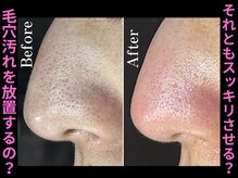 ティーツリー 名古屋 桜山(Tea Tree)/1回で黒ずみをしっかり除去！