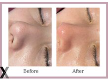 クロス(Xcross)/ハーブピーリング【毛穴/渋谷】