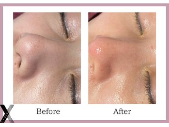 クロス(Xcross)/ハーブピーリング【毛穴/渋谷】