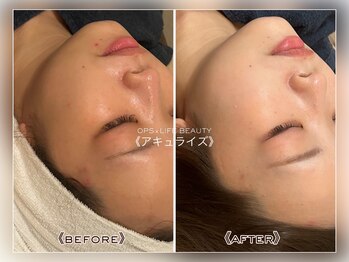 オプス ライフビューティー(OPS×LIFE BEAUTY)/顔つぼフェイシャルエステ