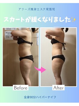 アリーズ エステ スウェイ(ally's esthe sway)/before,after