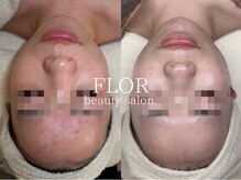 フロル(FLOR)の雰囲気（水光ピーリング【韓国肌管理】）