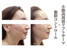 ベラ 東京院(Bella)の雰囲気（頬下の脂肪のもたつきをスッキリ【小顔/肌質改善/ひばりが丘】）