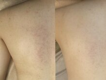 シュリー(Sriii)/背中のお手入れビフォーアフター