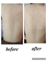 クリオネ(Clione)/嫌な背中の肌荒れ、黒ずみ後に★