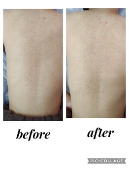 クリオネ(Clione)/嫌な背中の肌荒れ、黒ずみ後に★