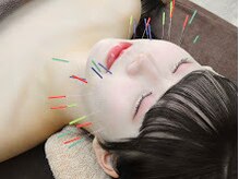 ヘルシースリムウエダ/施術風景【ひばりが丘/美容鍼】