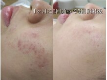 ココスターリー(Coco starry)/1ヶ月に2回、5ヶ月後