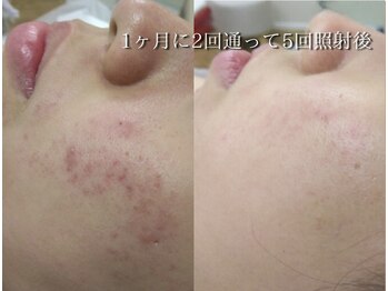 ココスターリー(Coco starry)/1ヶ月に2回、5ヶ月後