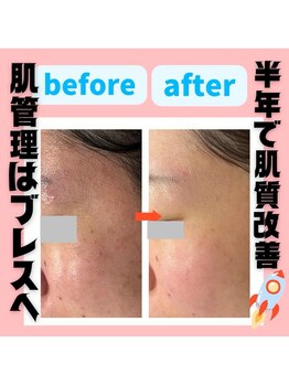 ブレス イオン酒田南店(BLESS)/自分史上最高の肌質へ