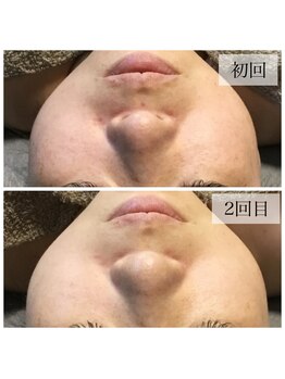 アウラ(AURA)/ハーブピーリングで美肌作り!