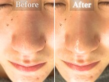 ボーンオム(Born Homme)/毛穴洗浄＋美容液導入：30代女性