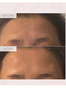 ハチハチ(808)/相模原美容鍼灸院眉間のシワ改善