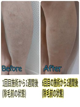 セルフ脱毛サロン SELFMADE イオンタウン仙台泉大沢店【3/29 NEW OPEN(予定)】 /【ビフォーアフター】セルフ脱毛