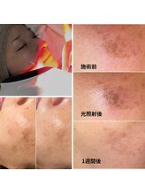 ル ボヌール/最新IPL光フェイシャル導入♪