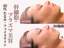 ベモーレ 谷町九丁目 上本町/40代プラズマ×幹細胞3回☆