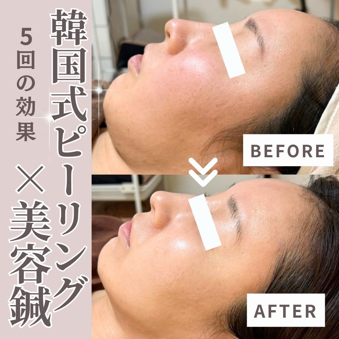 上野駅で毛穴ケアが人気のエステサロン｜ホットペッパービューティー