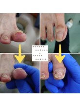 どうはく堂 西勝山接骨院/巻き爪卒業例