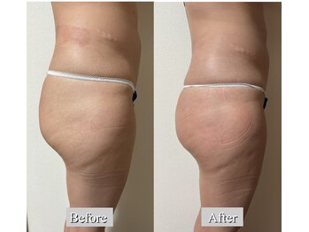 オレンジ(Orange)/2部位/痩身マシンBefore After