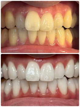 アンドホワイト 八日市店(&white)/メディカルホワイトニング