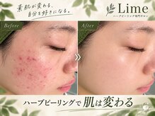 ライム 錦糸町(LIME)の雰囲気(お客様のお肌悩みに合わせた、丁寧なカウンセリング♪)