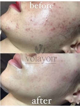 ペイジ(peige)/【peige】症例写真